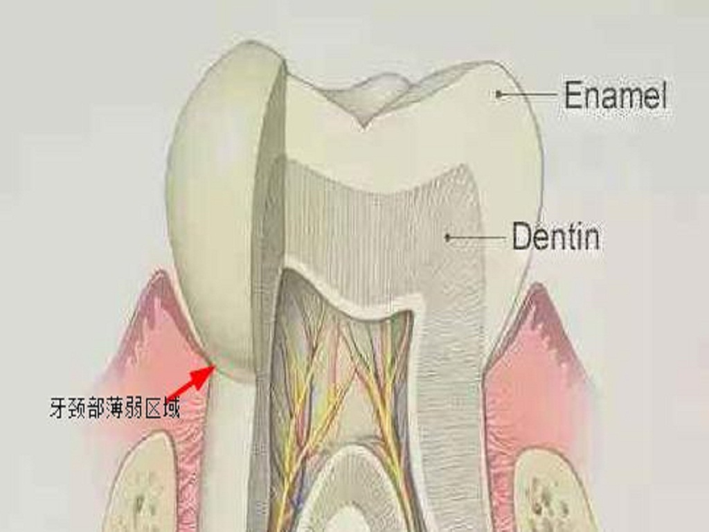不正确的刷牙多久会形成楔状缺损,不正确的刷牙方式导致牙根外露