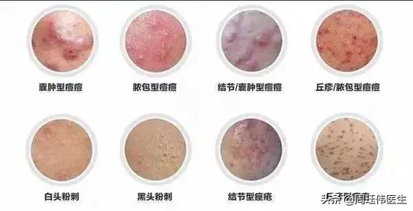 痘痘攻略小知识,教你改善痘痘的3种方法