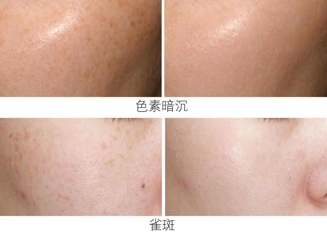 目前为止最温和无伤害的祛斑方法,揭秘有效祛斑方法大爆料