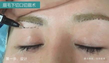 45岁眼皮耷拉下来怎么办,34岁上眼皮松弛需要提眉吗