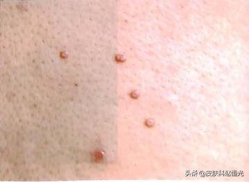 得了扁平疣要喝哪些中药调理,得了扁平疣口服什么药