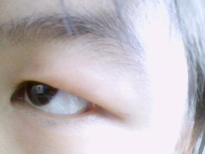 天生肿眼泡脂肪怎么消除,肿眼泡怎么分清皮肤厚和脂肪多