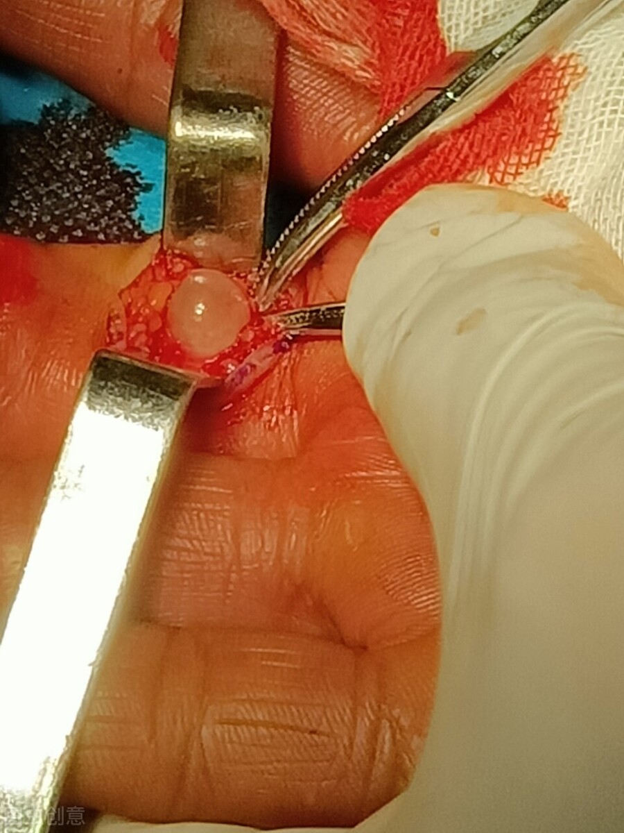 腱鞘囊肿开刀会碰到筋吗,腱鞘囊肿不想去医院自己怎样康复