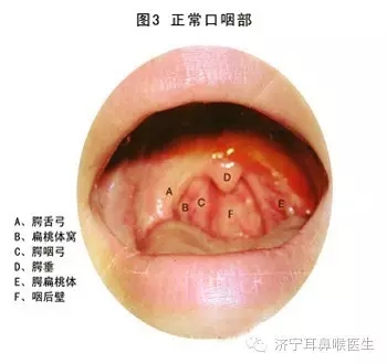 慢性咽炎冷冻可以除根吗,慢性咽炎除根的西药