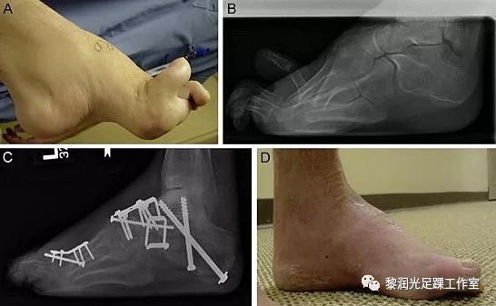 伊里扎洛夫外固定架治疗足部畸形,足部畸形矫正的技巧