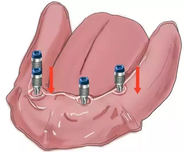 镶牙手绘图,镶牙图片过程