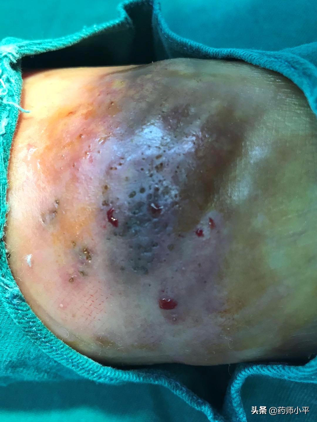 美国真菌感染死亡人数,美国超级真菌感染的症状