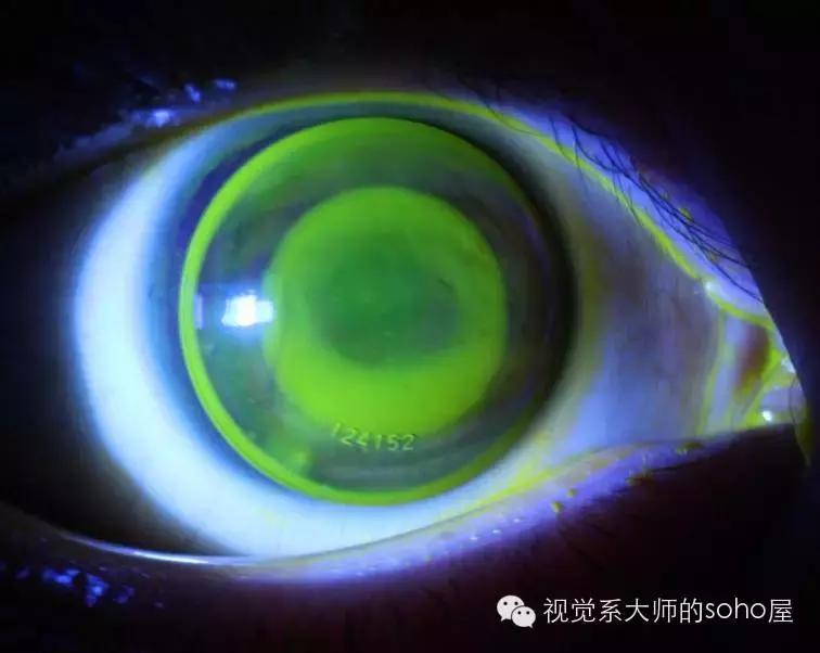 如何选择角膜塑形镜的品牌,怎么选角膜塑形镜的参数