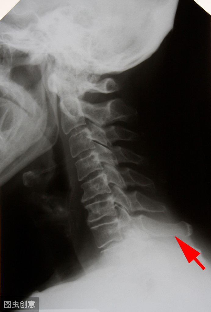 脖子后面鼓个包疼咋回事,脖子后面有结节说明颈椎病严重吗