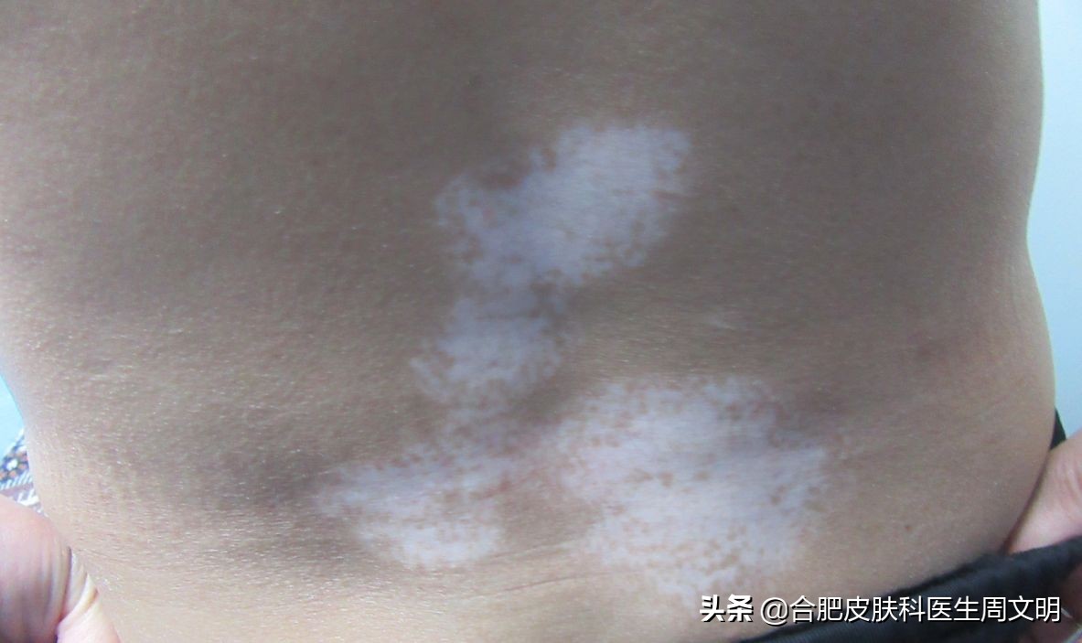 白癜风牛皮癣皮肤病为什么难治,白癜风治不好病情反复原因