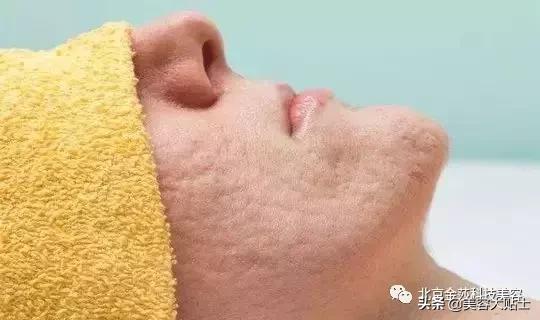 怎么跟自己的痘坑和解,一个痘坑自己在家如何处理