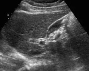 儿童胆囊结石喝药能化掉吗,儿童多发性胆囊结石一定要切除吗