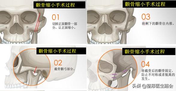 颧骨大小不对称怎么磨骨,如何分辨颧骨是高还是低