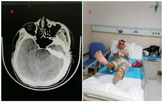脑梗死错过黄金救治溶栓窗口期,脑梗抢救黄金时间消栓术