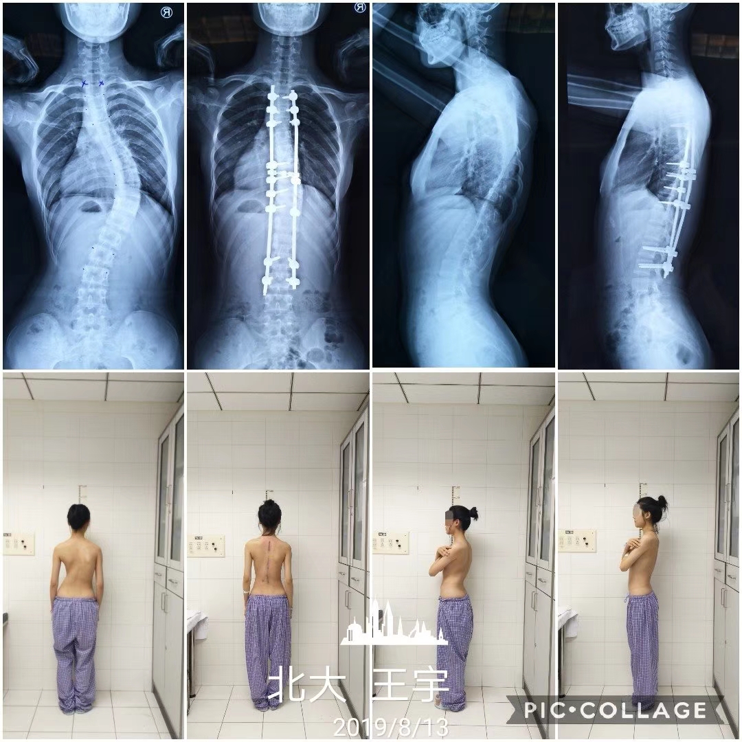 脊柱侧弯平躺下来症状消失,婴幼儿脊柱侧弯有什么症状