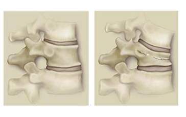 椎间盘突出腰痛时在家怎么办,椎间盘突出腰痛最快恢复方法