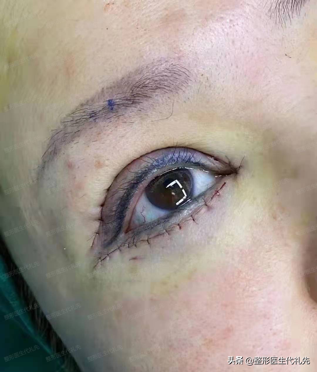 做全切双眼皮去眼袋恢复过程,45岁全切双眼皮亲身经历