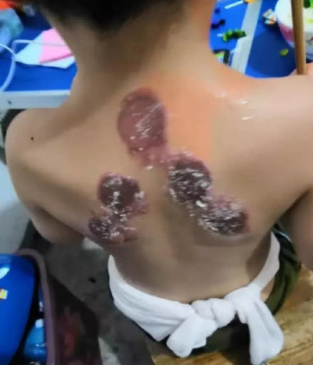 贵阳小孩子贴敷被灼伤,小孩贴三伏贴红肿起泡正常吗