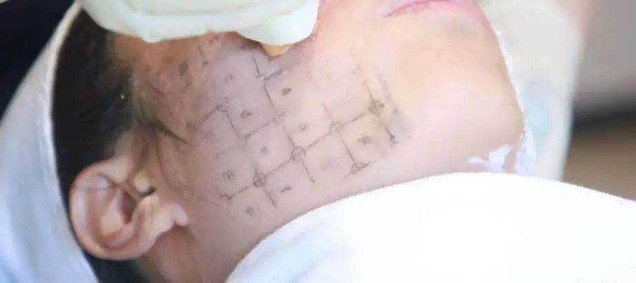 “无痛版热玛吉”问世，抗衰市场迎来最强玩家？