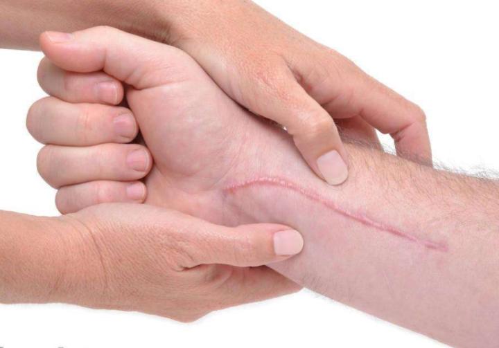 如果受伤了怎么处理才不会留疤,受伤不想留疤不能吃什么