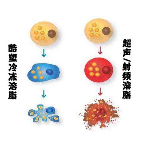 酷塑冷冻溶脂副作用是什么样的,酷塑冷冻溶脂的真实经历对比