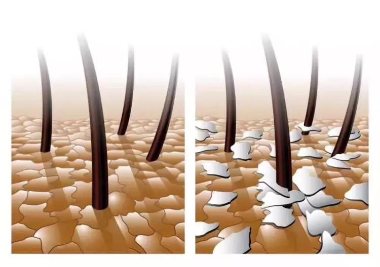 头皮屑多怎么办小妙招不需要钱,头皮屑多怎么办9个方法告别头屑