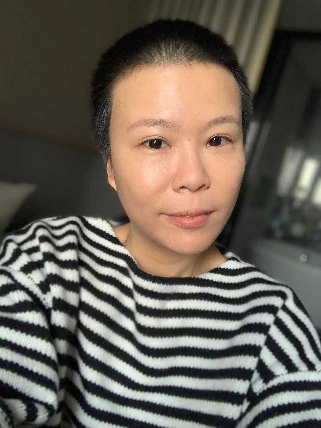 做了微整之后的感悟,微整经验