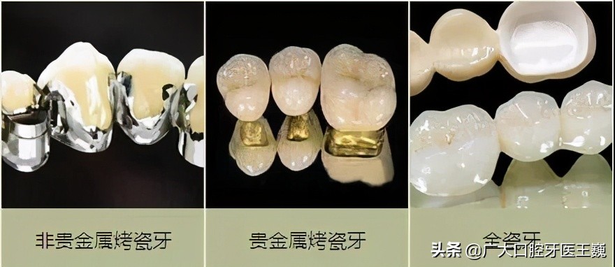 全瓷牙与烤瓷牙哪种好,好的烤瓷牙和便宜的全瓷牙的区别