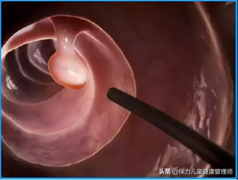 结肠癌知识普及,结肠癌肿瘤10公分严重吗