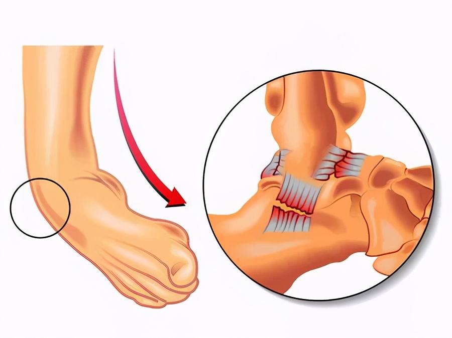 崴脚后48小时后怎么处理最好,崴脚脖子怎么处理好得最快