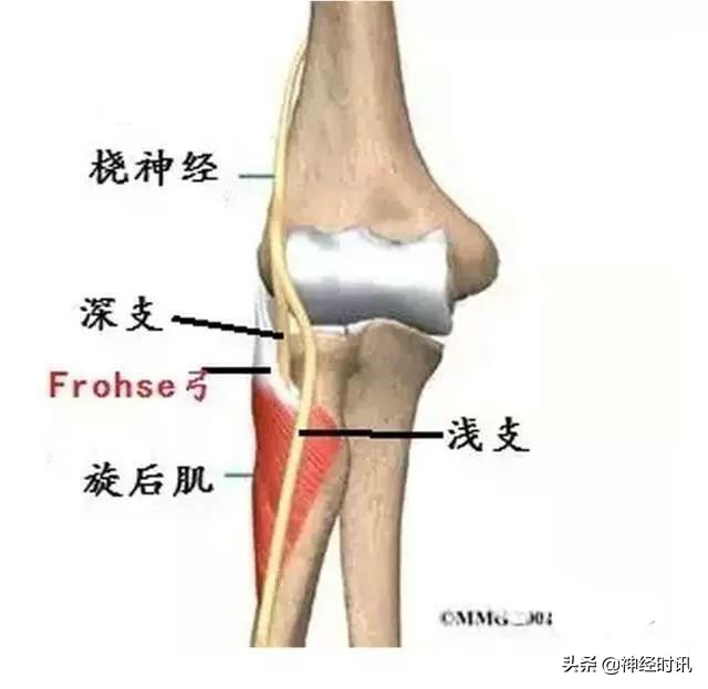 周围神经卡压解剖与分析,腓浅神经卡压解剖视频