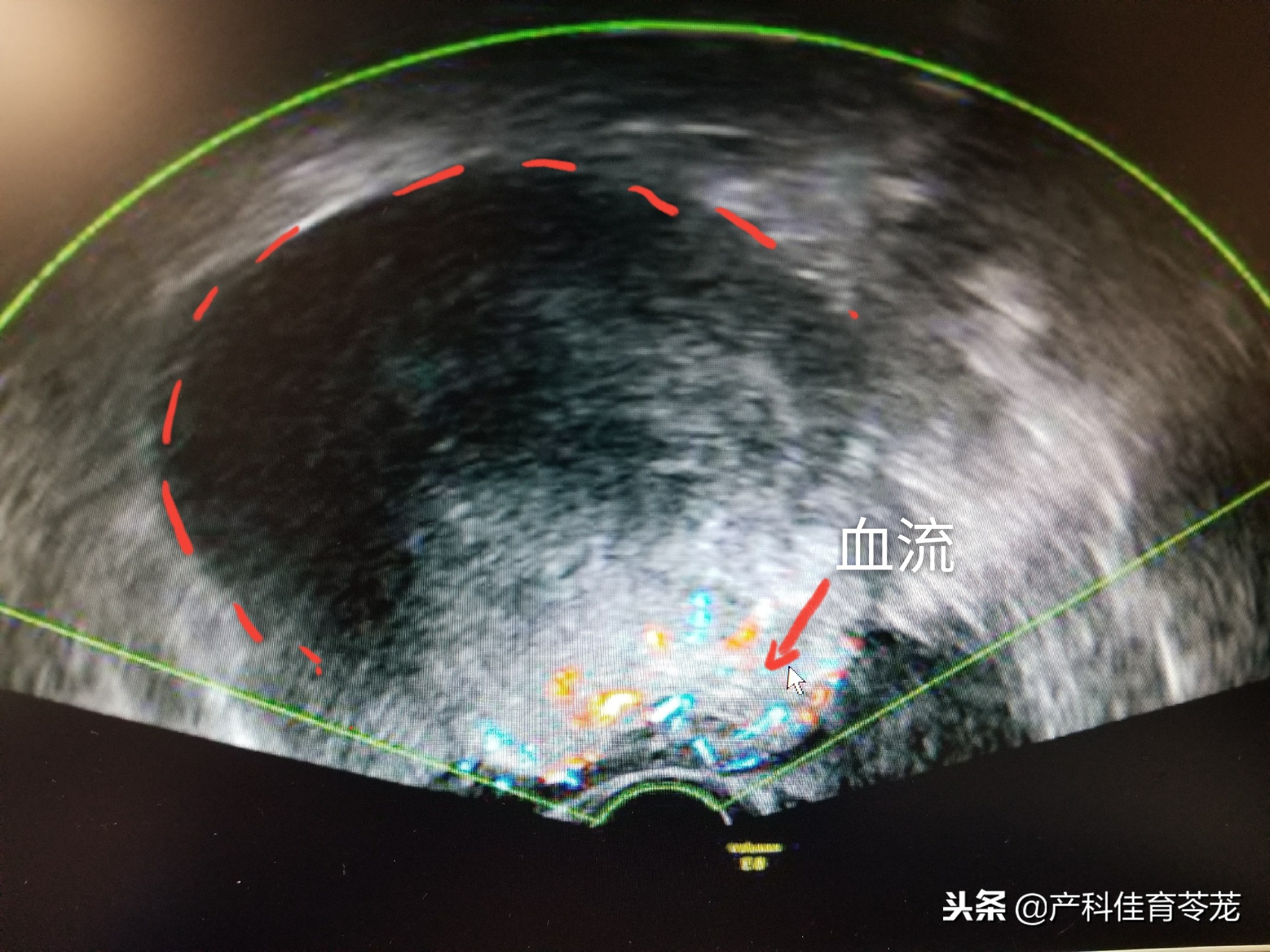 做b超能查卵巢和输卵管异常吗,b超下卵巢大小正常值是多少