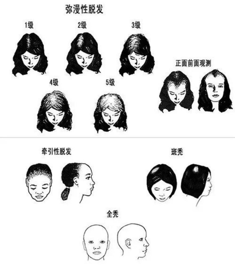 女人秃了一块怎么办,女性其实比男性秃