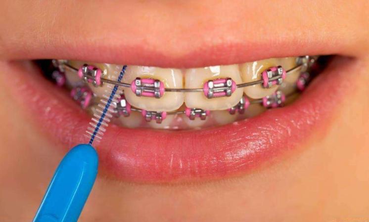 牙齿矫正打骨钉后注意事项,牙齿矫正取下牙套需要注意什么
