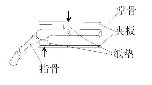 拳击手骨折手背凸起,了解什么是拳击手骨折