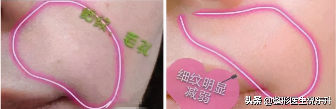 在脸上扎几百万个洞的“水光针”，效果到底怎样？