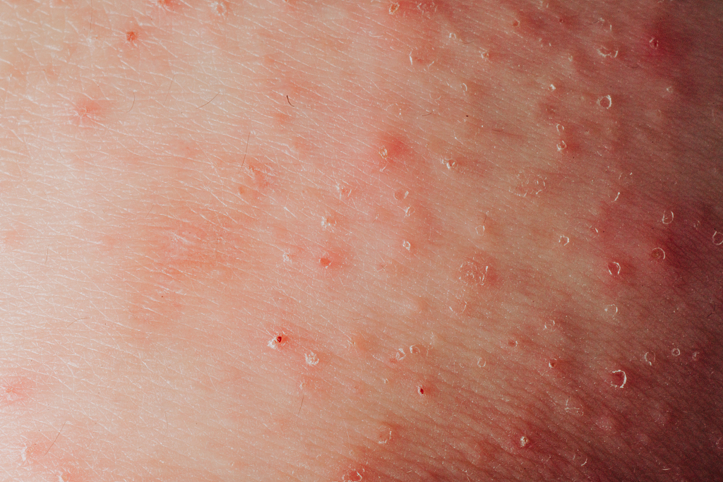 湿疹严重有什么忌口,湿疹过来人的独家秘籍