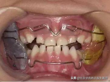 腺样体肥大牙齿矫正最佳年龄,儿童龅牙牙齿矫正最佳年龄