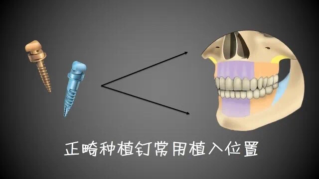 矫正牙齿在牙龈打钉子多久能取,整牙一定要在牙龈里打钉子吗