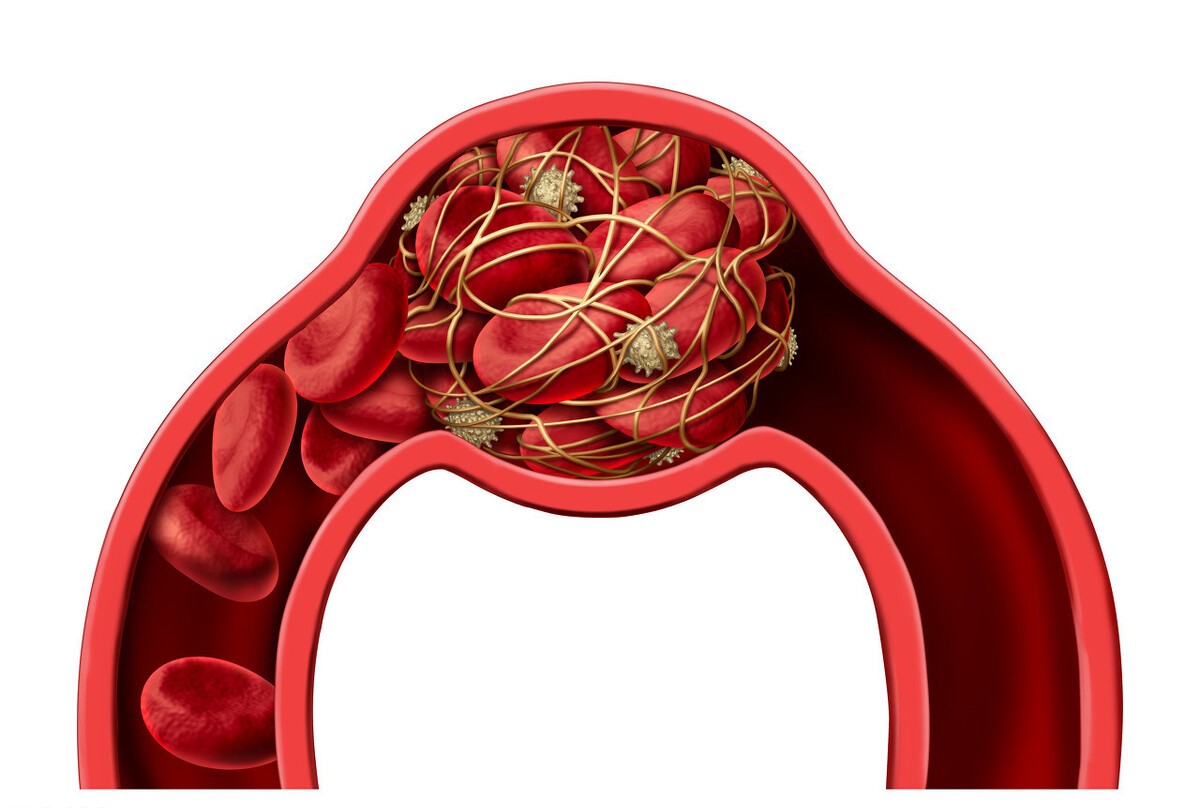 房颤血栓和斑块破裂的血栓一样吗,房颤时预防动脉血栓最有效的药物