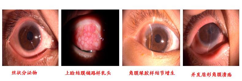 过敏性结膜炎眨眼睛很严重,眼角奇痒无比是角膜炎还是结膜炎