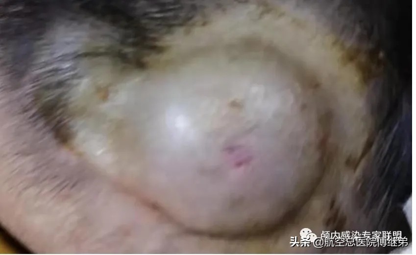 婴儿脑积水治疗方法动画演示,ommaya囊植入术是大手术吗