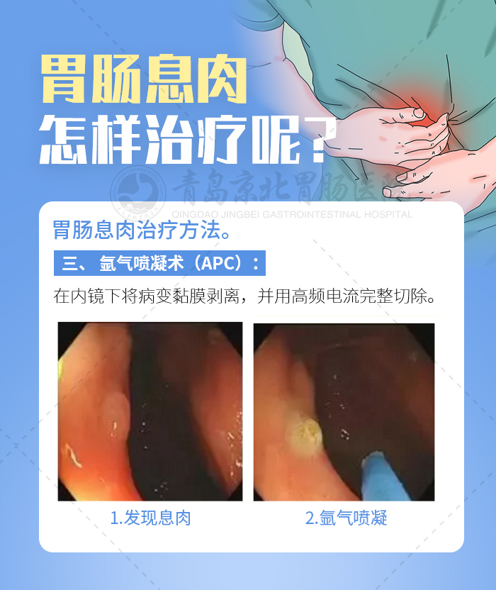 胃肠镜发现有息肉严重吗,肠镜多大息肉可内镜下切除