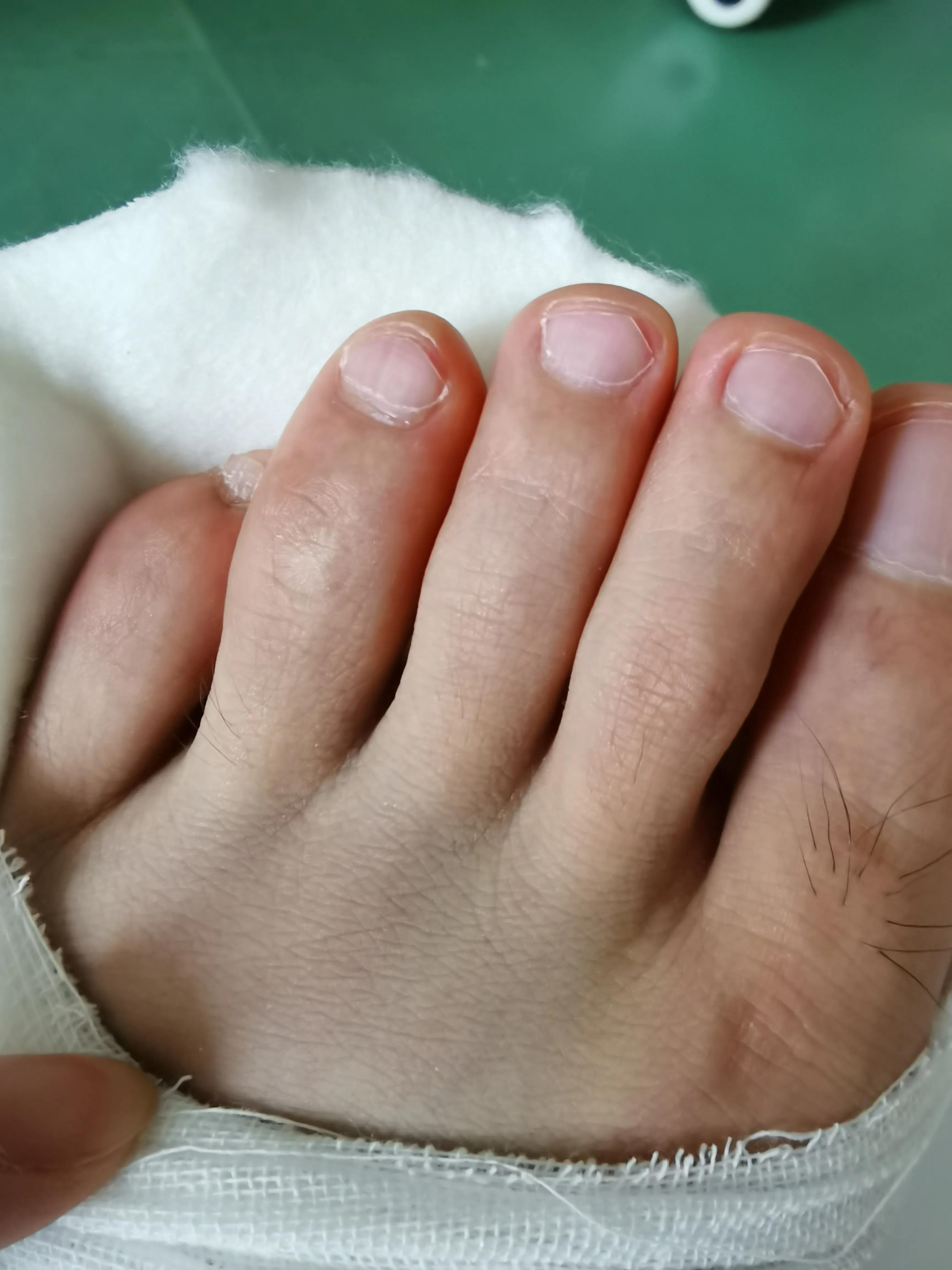 第五跖骨基底部骨折60天能走路吗,第五跖骨基底部骨折60天能脱拐吗