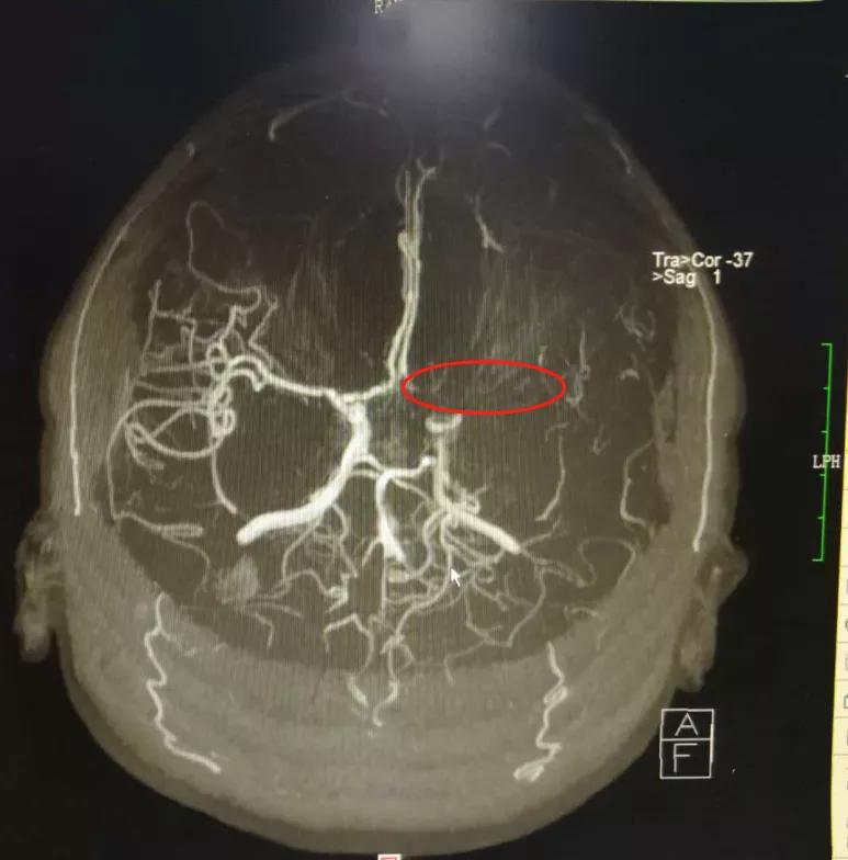 颅内动脉支架成形术，让塌陷的颅内动脉重获新生