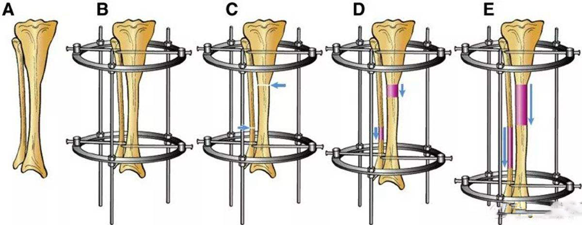 中国有没有断骨增高手术,什么是断骨增高手术