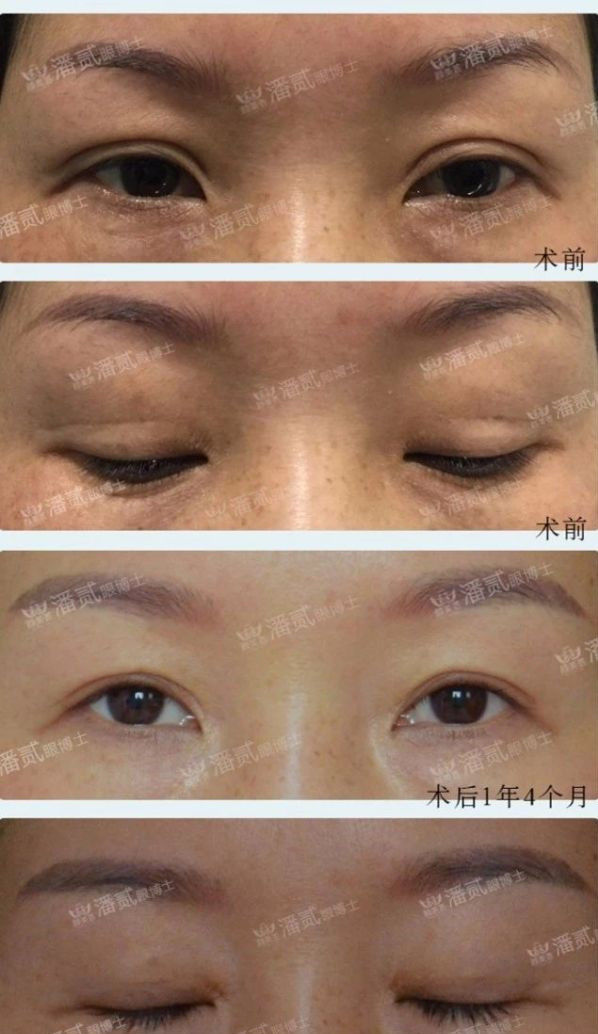 双眼皮失败眼角处有褶皱,双眼皮失败后闭眼痕迹