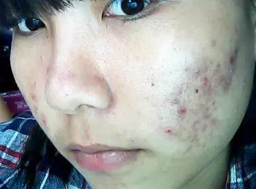 分享祛斑经验,祛痘分享