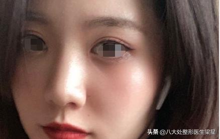 双眼皮手术开眼角恢复过程,双眼皮全切开眼角恢复期图