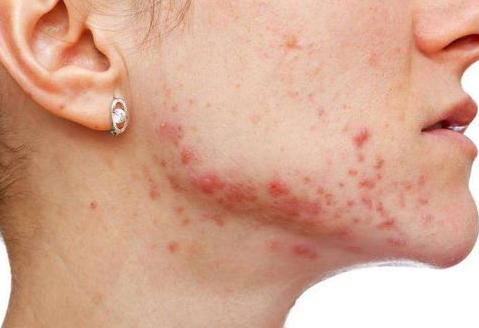 前胸后背长痘痘是毛囊炎吗,前胸后背很容易长痘痘中医治疗